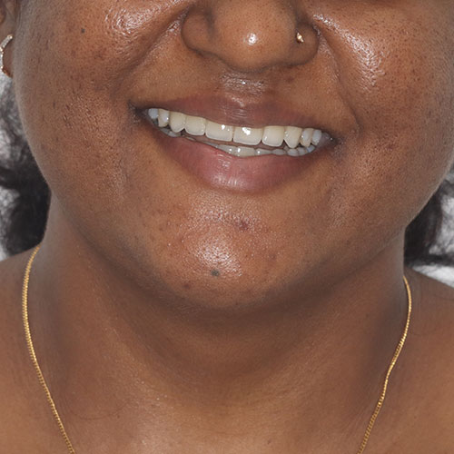 After - smile design