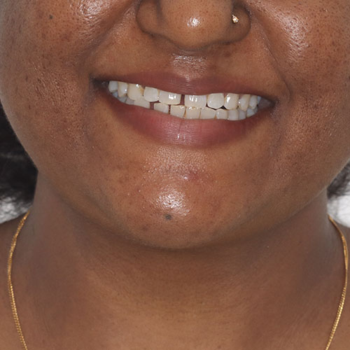 Before - smile design