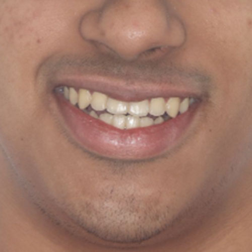 After - Invisalign