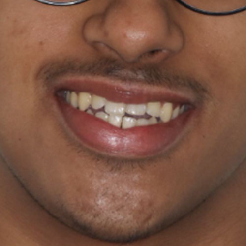 Before - Invisalign